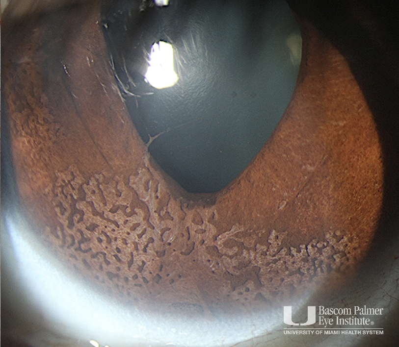 IE080222OI Iridocorneal Endothelial (ICE) Syndrome, CoganReese/Iris